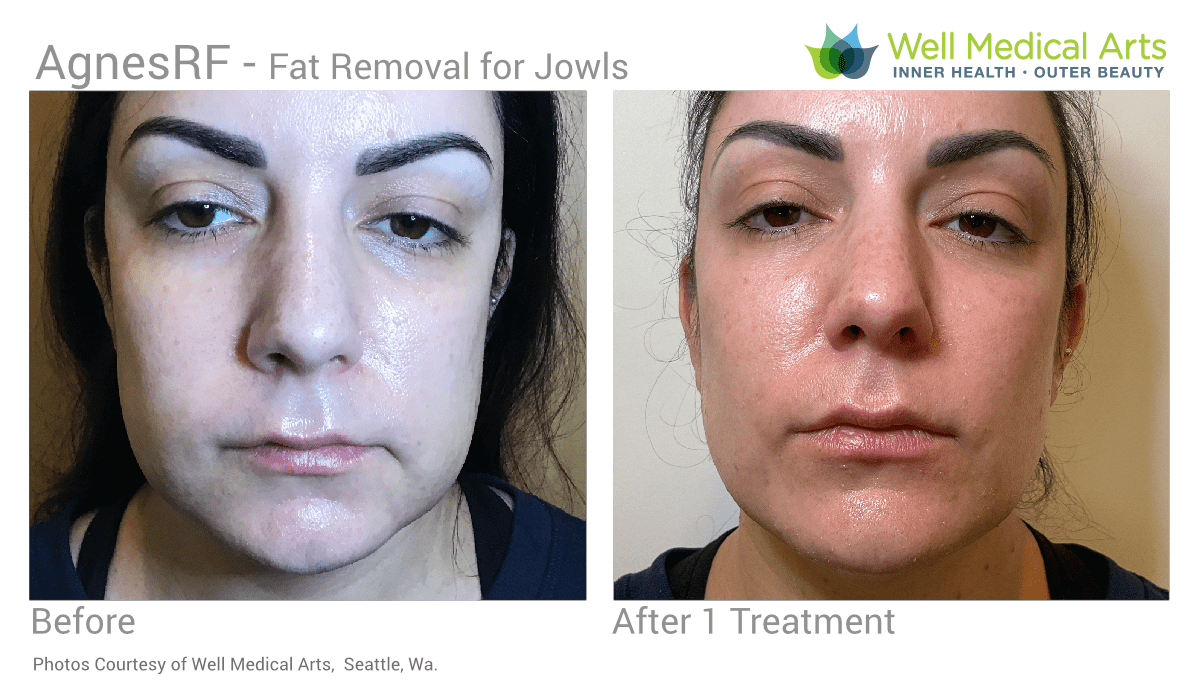 AGNES RF Fat Removal Before And After For The Jowls In Seattle At Well Medical Arts