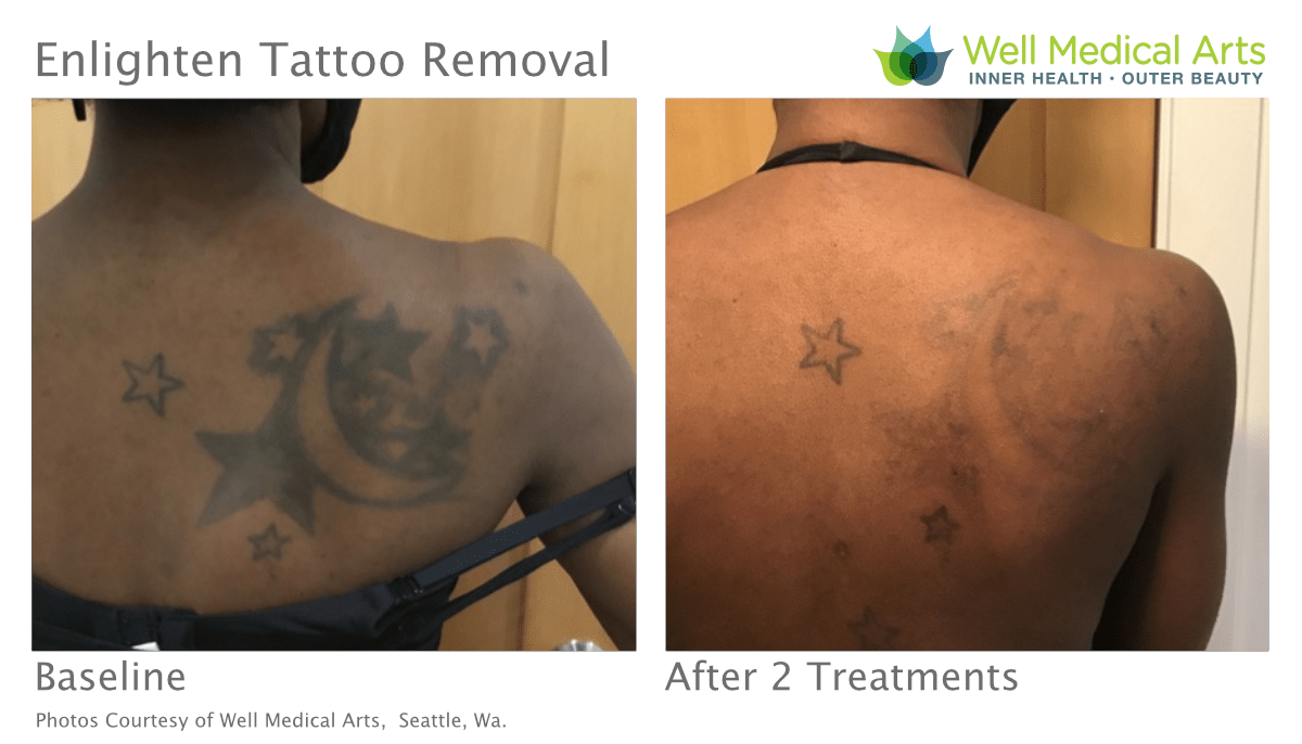 Tattoo Removal Before And After Treatment # 2 On Dark Skin Using The Cutera Enlighten At Well Medical Arts In Seattle.