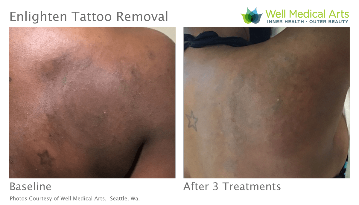 Tattoo Removal Before And After Treatment # 3 On Dark Skin Using The Cutera Enlighten At Well Medical Arts In Seattle.