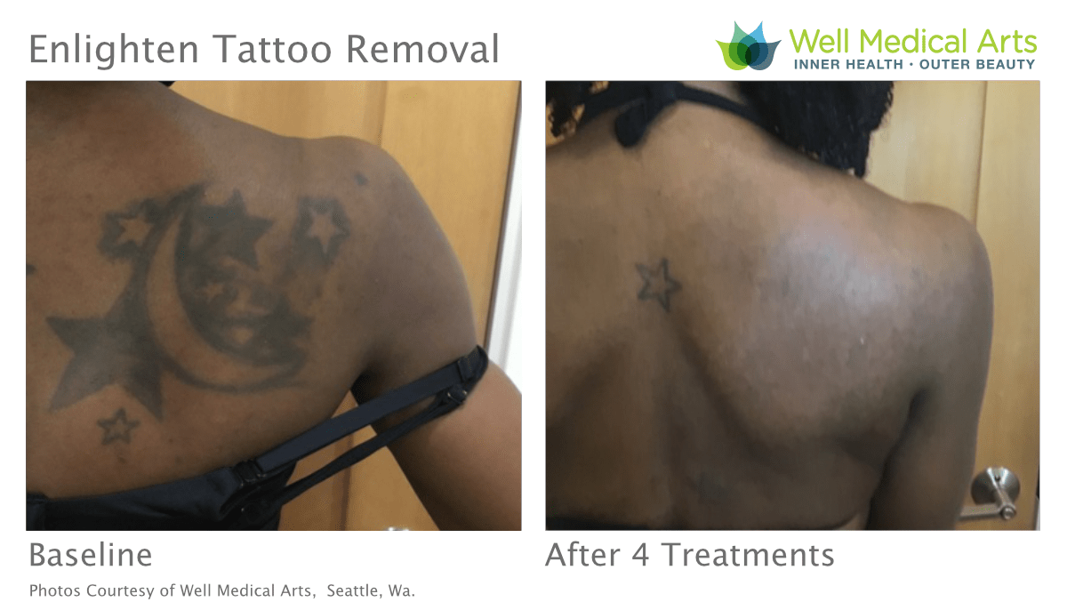 Tattoo Removal Before And After Treatment #4 On Dark Skin Using The Cutera Enlighten At Well Medical Arts In Seattle