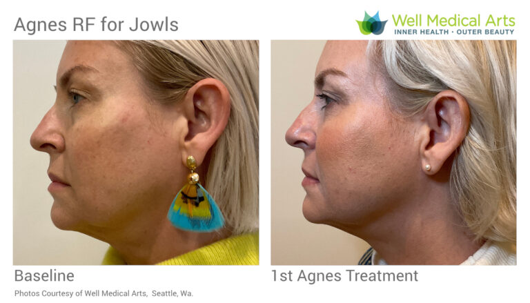 Agnes RF in West Seattle | Tighten, Smooth, Sculpt