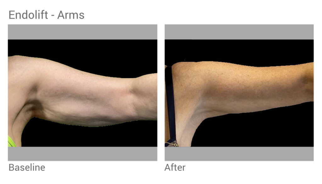 Endolift tightens skin and reduces fat in Seattle at Well Medical Arts