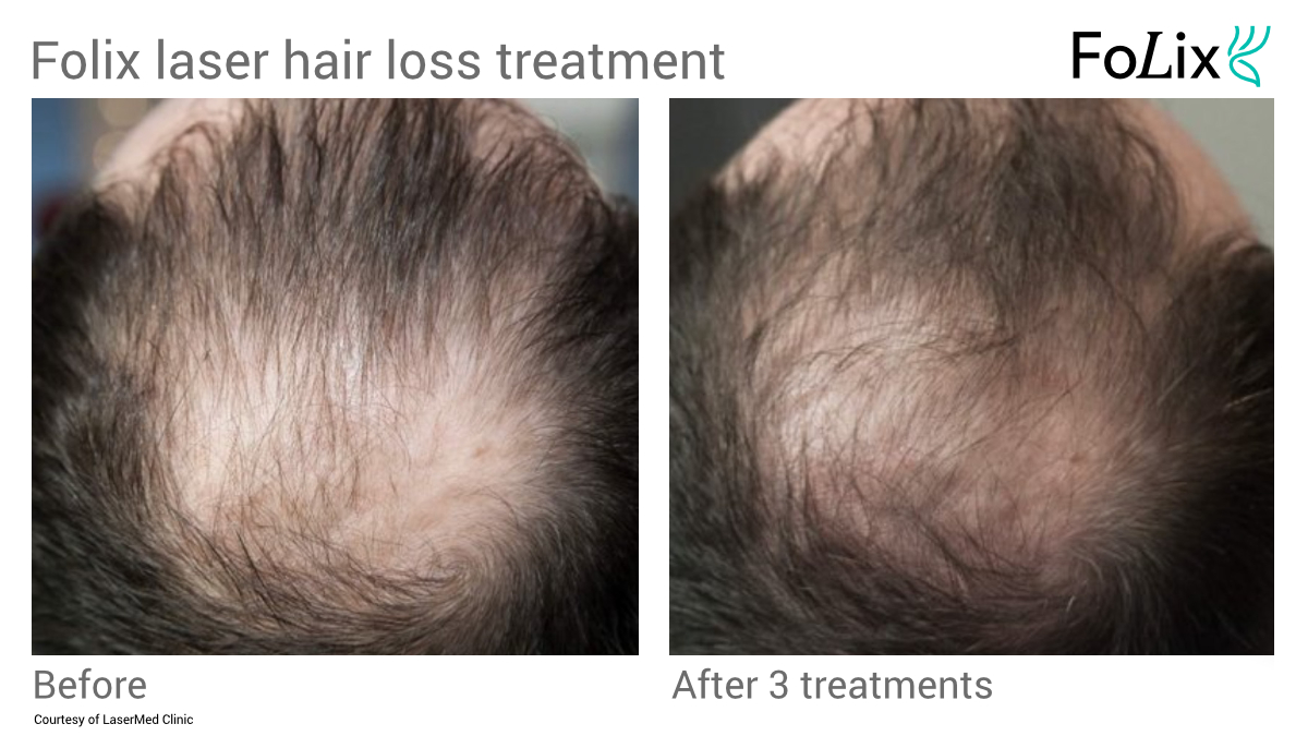 FOLIX Laser hair treatment for male pattern baldness in Seattle at Well Medical Arts Before and After Men 15