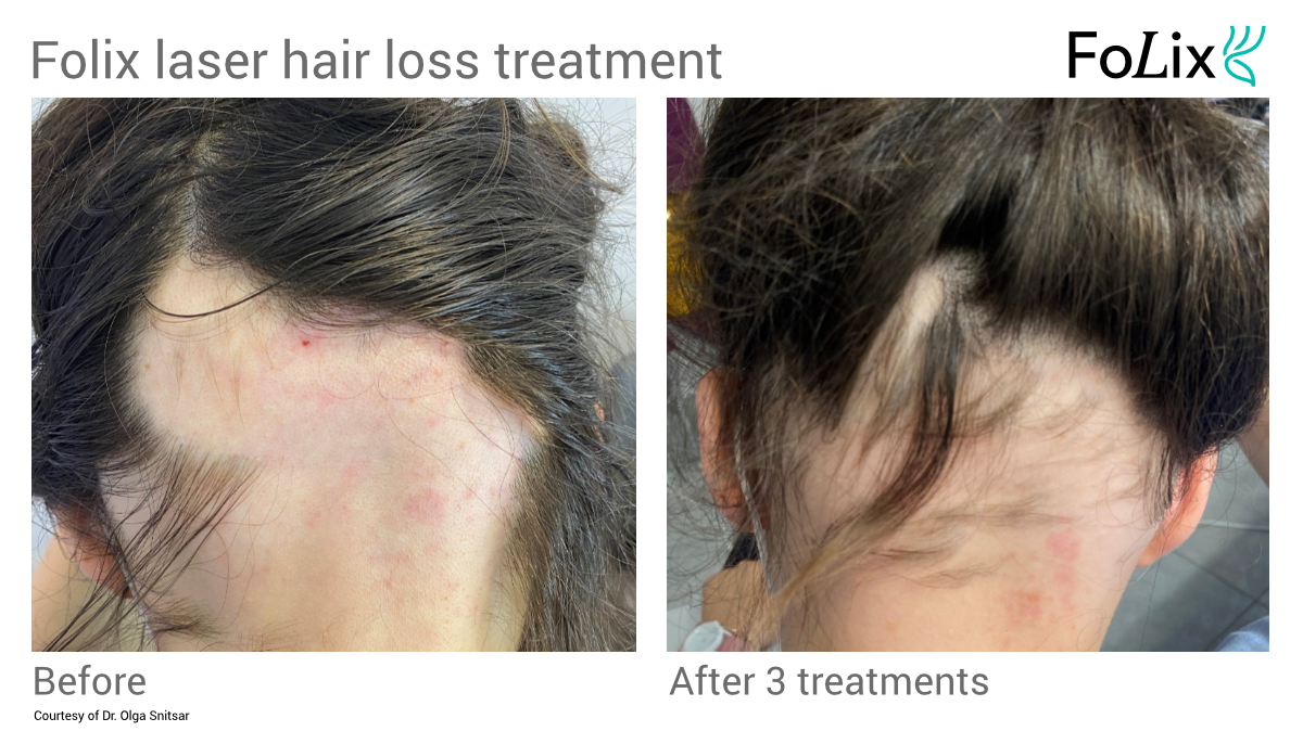 FOLIX alopecia hair restoration in Seattle at Well Medical Arts Before and after Women 12