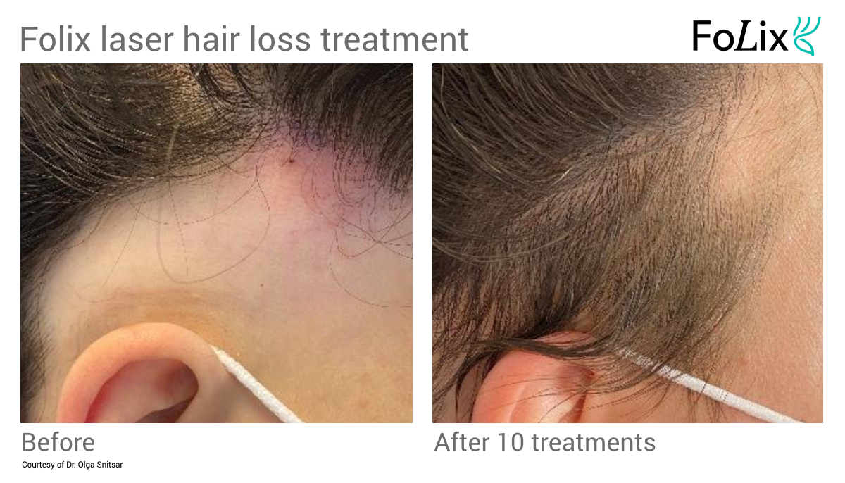 FOLIX alopecia hair restoration treatment in Seattle at Well Medical Arts Before and after Women 13