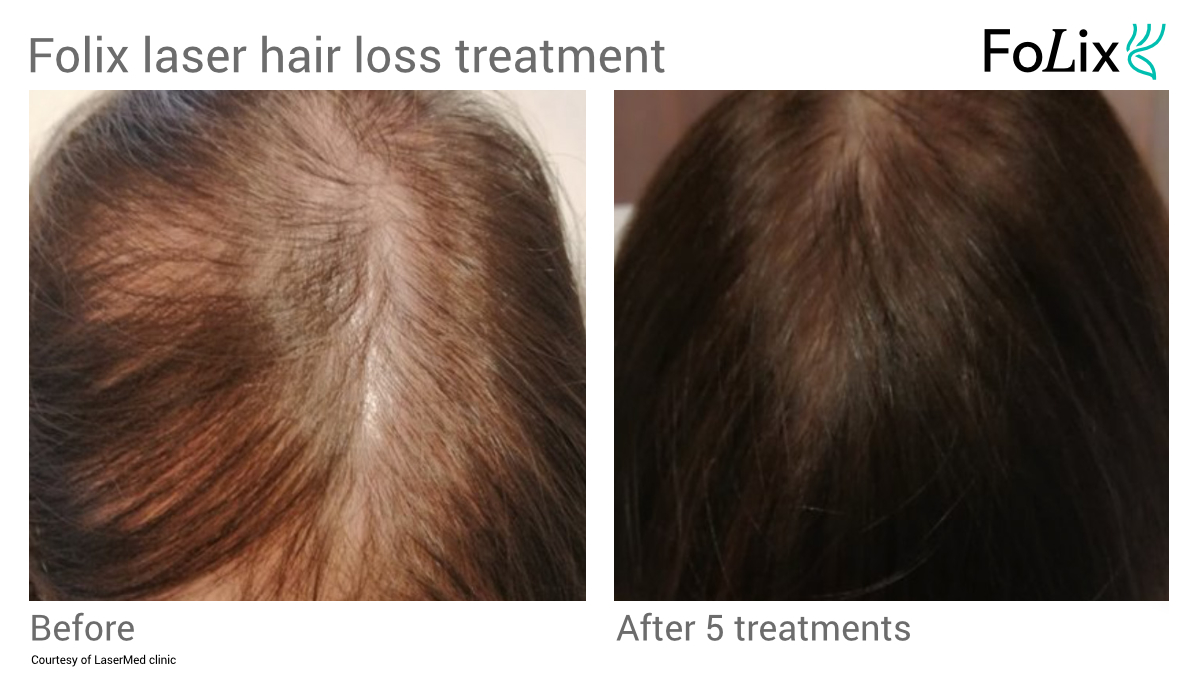 FOLIX hair regrowth treatment in Seattle at Well Medical Arts Before and After Women 5