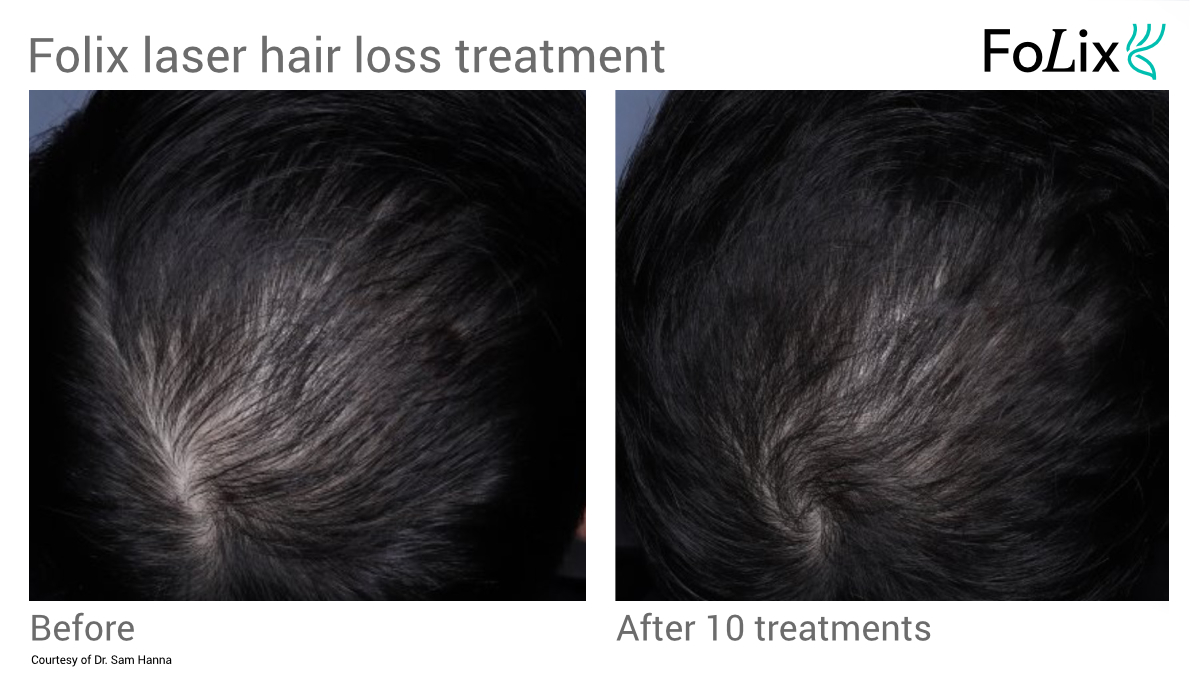 FOLIX hair restoration for Men in Seattle at Well Medical Arts - Before and after 20. Thinning hair at the crown of your head can be treated. Learn more at folix-hair-loss-treatment-seattle