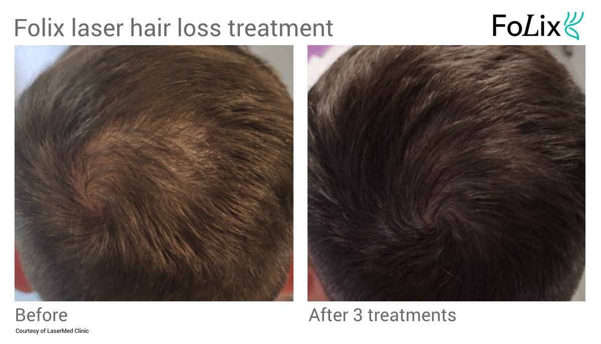 FOLIX hair restoration in Seattle at Well Medical Arts - Before After - Men 19