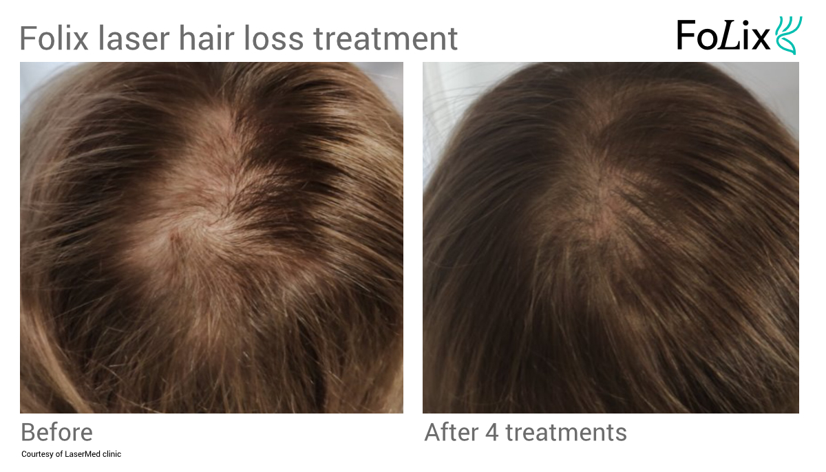 FOLIX hair restoration in Seattle at Well Medical Arts Before and After Women 6