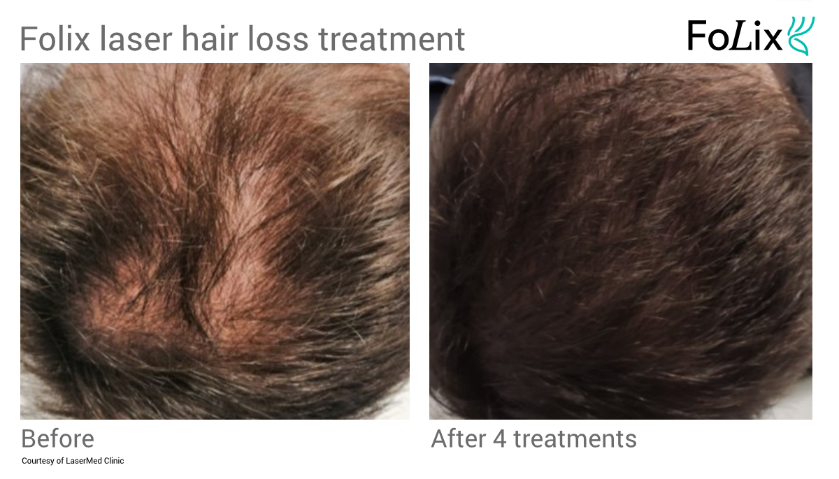 FOLIX hair restoration treatment in Seattle at Well Medical Arts Before and after Men 16