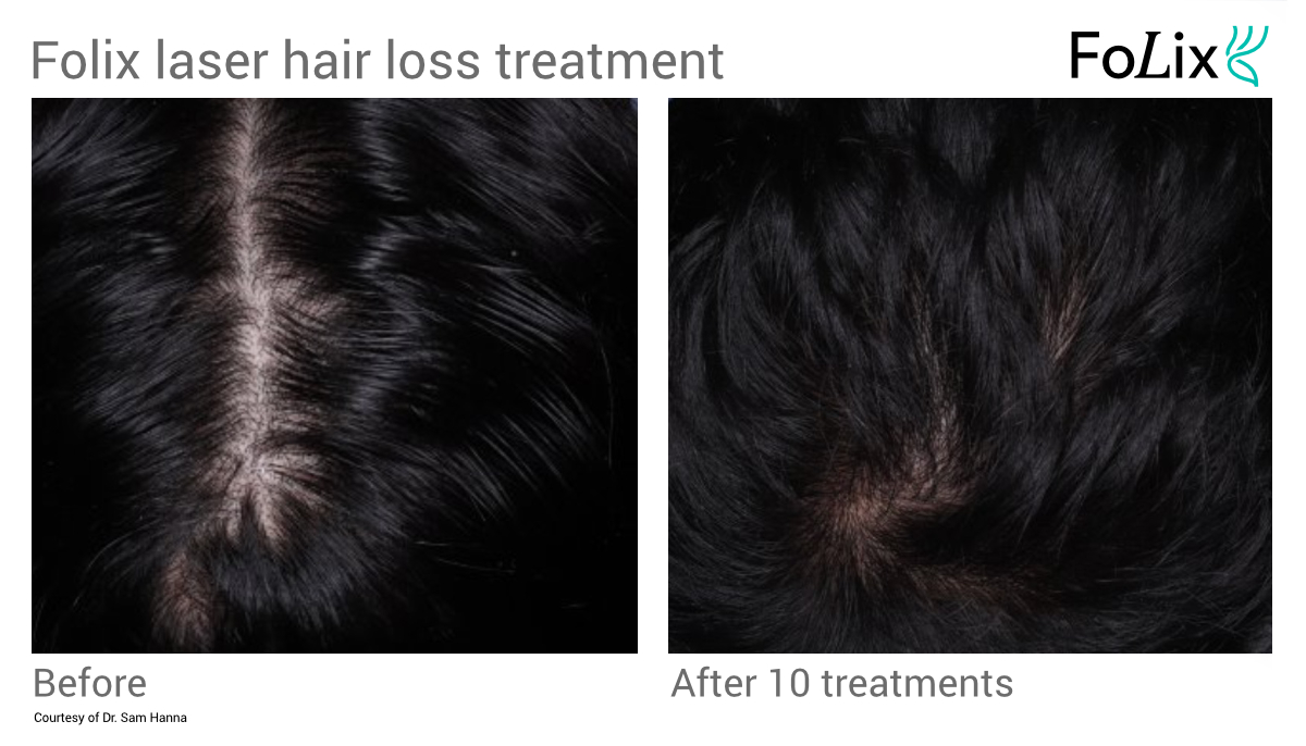 FOLIX hair treatment in Seattle at Well Medical Arts - Before After - Men 21