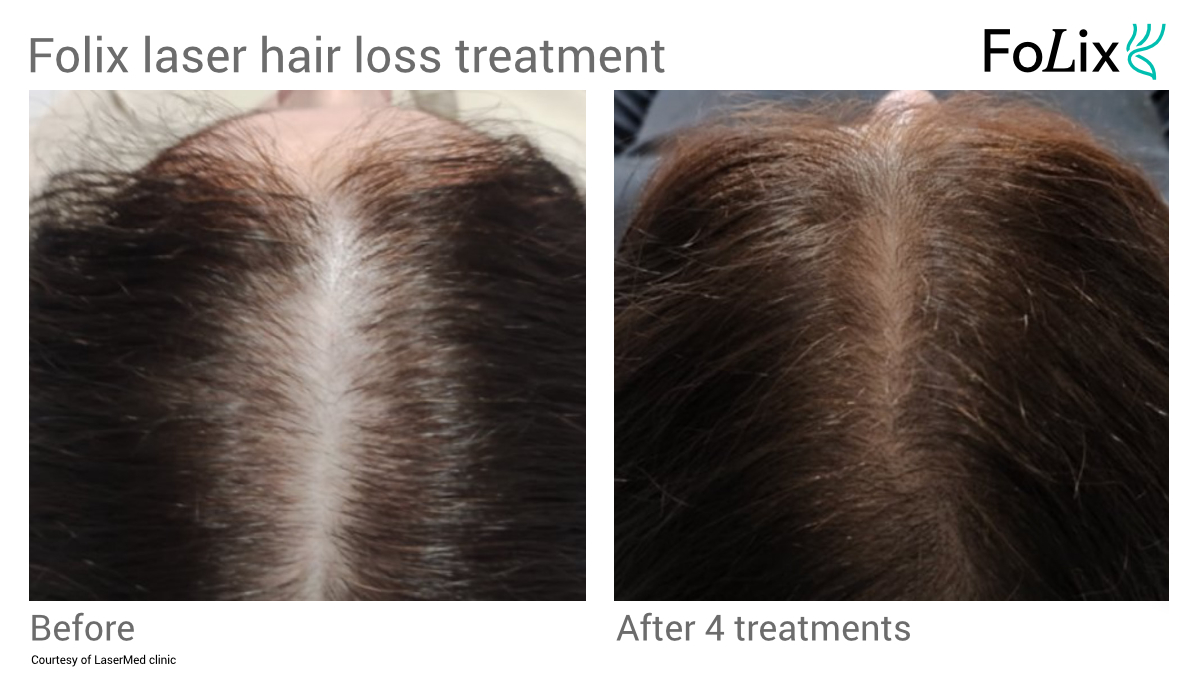 FOLIX hair treatment in Seattle at Well Medical Arts Before After Women 7