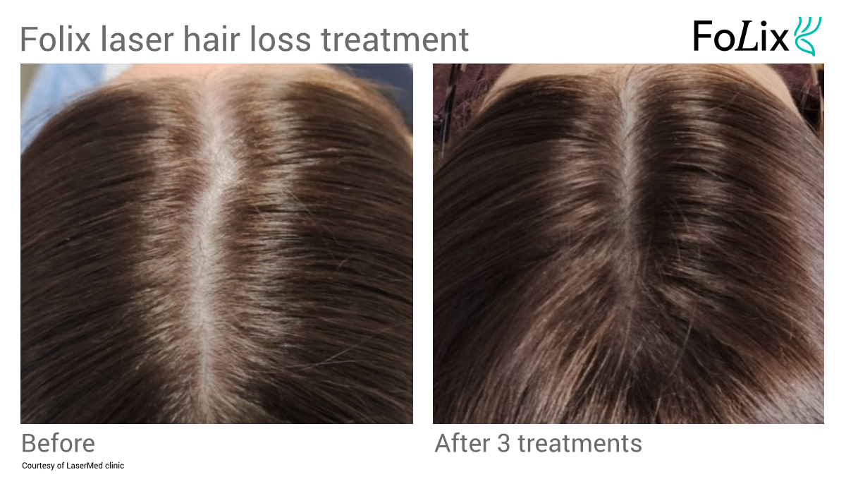 FOLIX hair treatment in Seattle at Well Medical Arts Before and After Women 4
