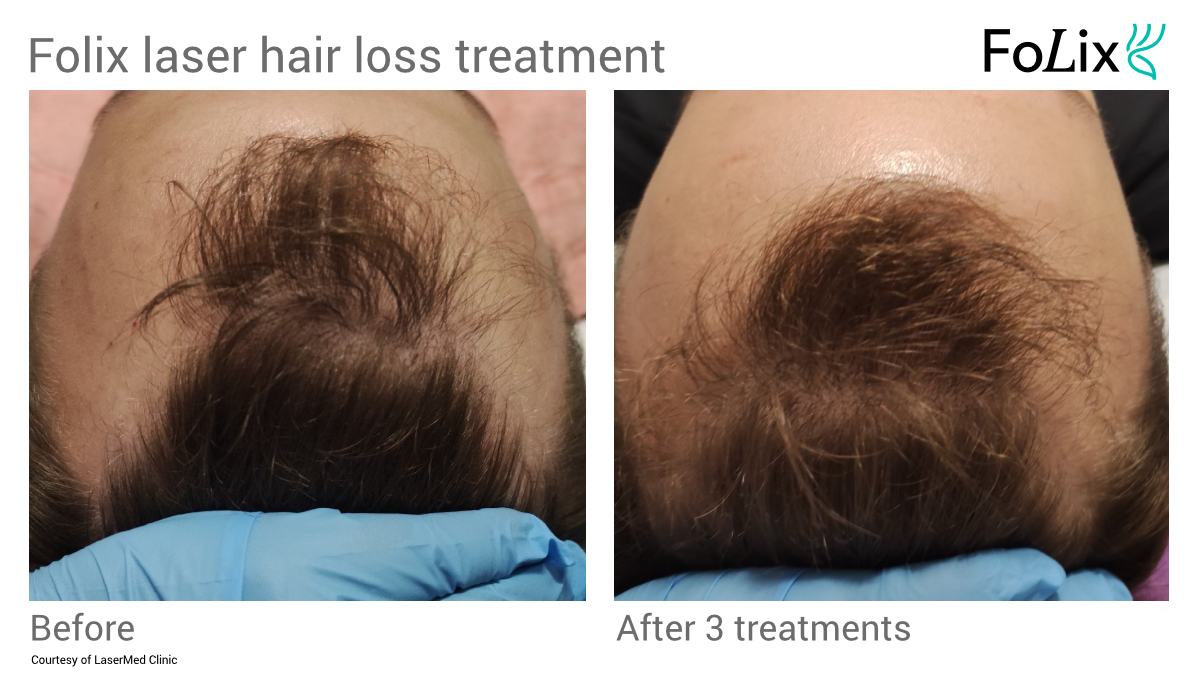 FOLIX treatment for receding hairline in Seattle at Well Medical Arts - Before and after - Men 23