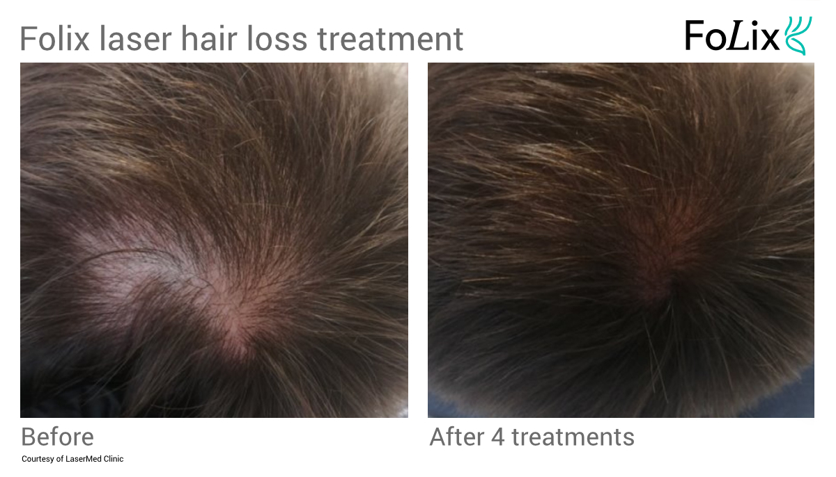 FOLIX laser hair restoration for thinning hair in Seattle at Well Medical Arts - Before After Men 18