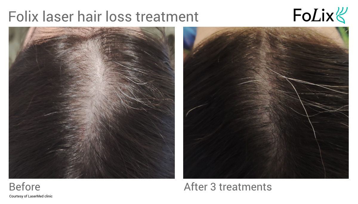 FOLIX laser hair restoration in Seattle at Well Medical Arts Before and After women 3