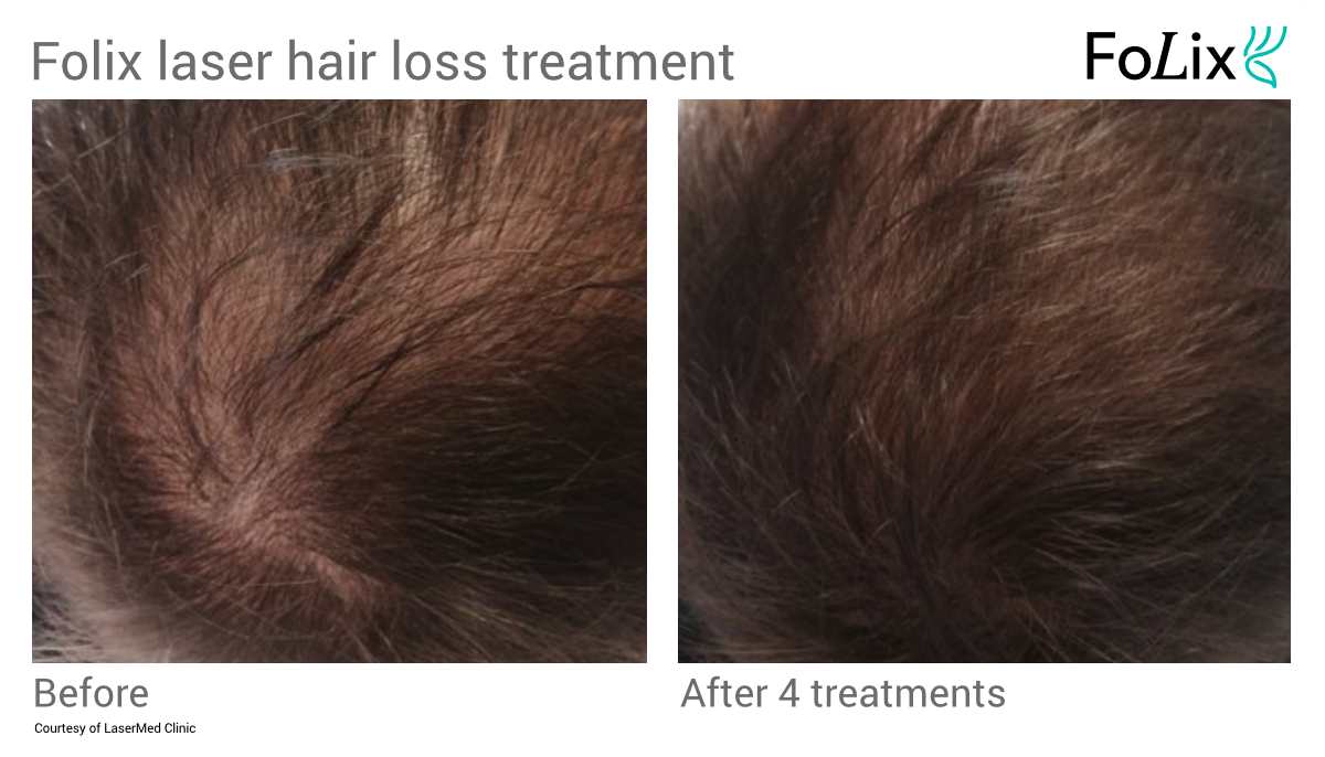 Seattle FOLIX laser hair treatment at Well Medical Arts Before and after men 17