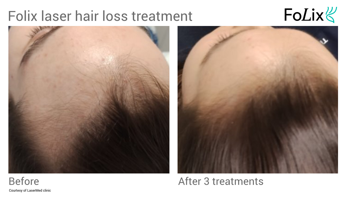 FOLIX laser hair treatment in Seattle at Well Medical Arts Before and After Women 10
