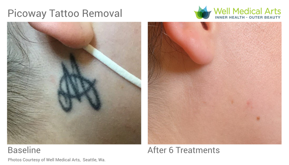 More great tattoo removal before and afters at Well Medical Arts in Seattle. 6 Treatments on this neck tattoo took care of it.
