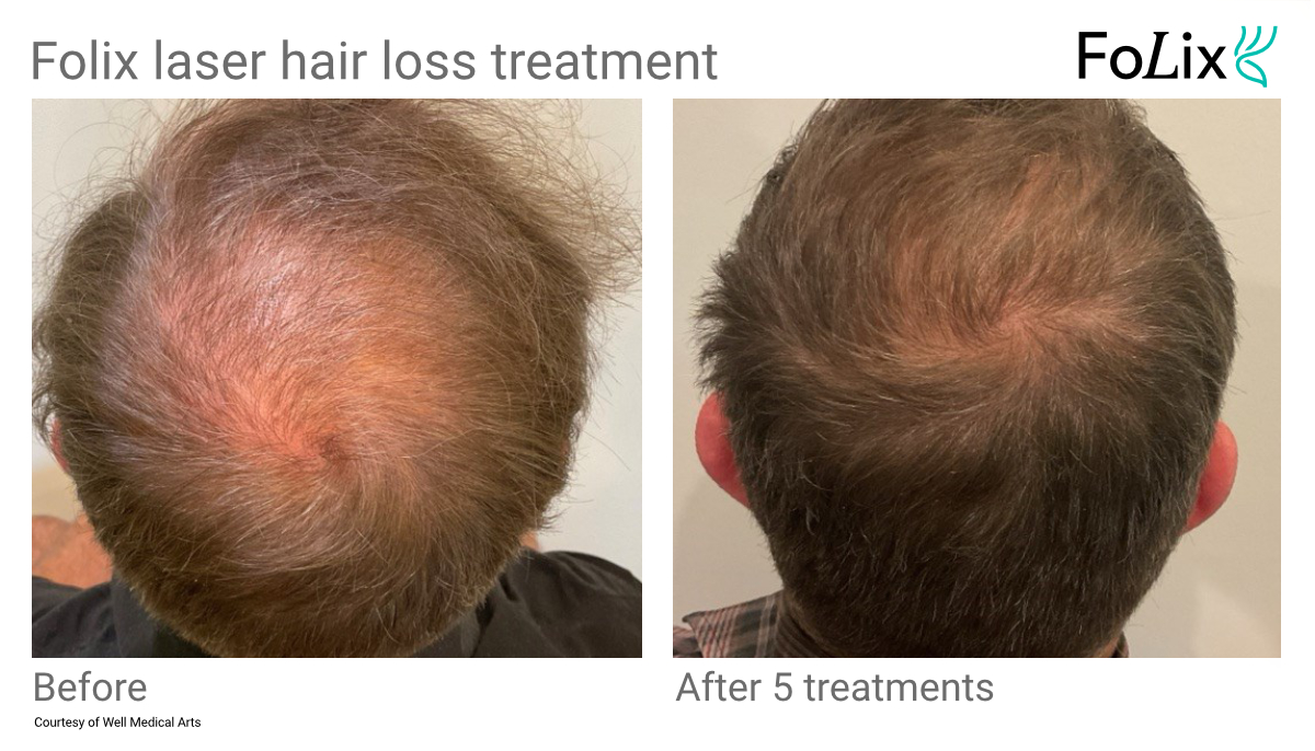 Folix laser Hair restoration in Seattle at Well Medical Arts. No Surgery, no needles, no downtime.